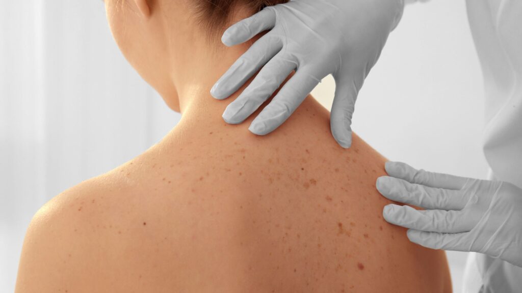 Skin Cancer Checks Sandringham